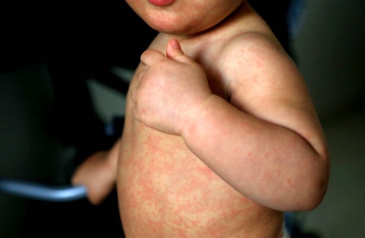 child with measles symptoms salvador, bahia / brazil - february 14, 2017: Child with measles symptoms is seen with small red spots on body and feverish state. *** Local Caption *** . SALVADOR BAHIA BRASIL Copyright: xJoaxSouzax 220117JOA05Z,Image: 803183975, License: Rights-managed, Restrictions: imago is entitled to issue a simple usage license at the time of provision. Personality and trademark rights as well as copyright laws regarding art-works shown must be observed. Commercial use at your own risk., Credit images as "Profimedia/ IMAGO", Model Release: no