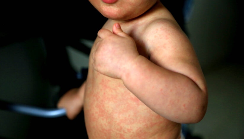 child with measles symptoms salvador, bahia / brazil - february 14, 2017: Child with measles symptoms is seen with small red spots on body and feverish state. *** Local Caption *** . SALVADOR BAHIA BRASIL Copyright: xJoaxSouzax 220117JOA05Z,Image: 803183975, License: Rights-managed, Restrictions: imago is entitled to issue a simple usage license at the time of provision. Personality and trademark rights as well as copyright laws regarding art-works shown must be observed. Commercial use at your own risk., Credit images as "Profimedia/ IMAGO", Model Release: no