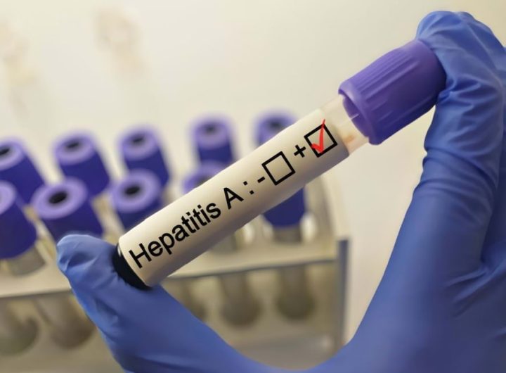 hepatita-a