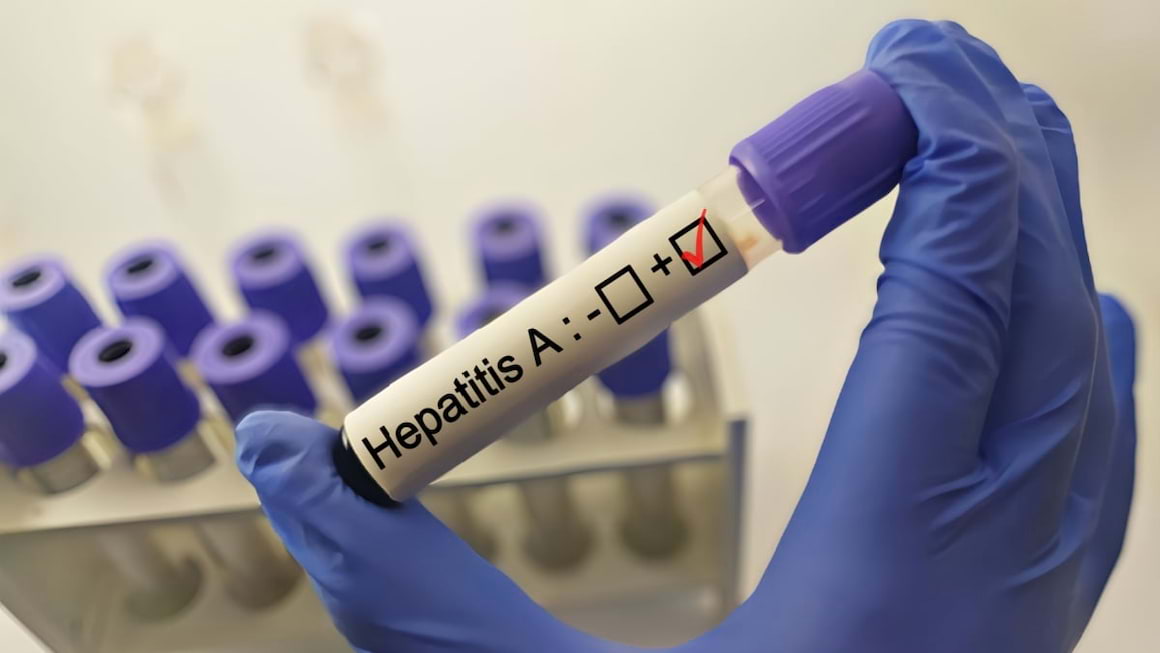 hepatita-a